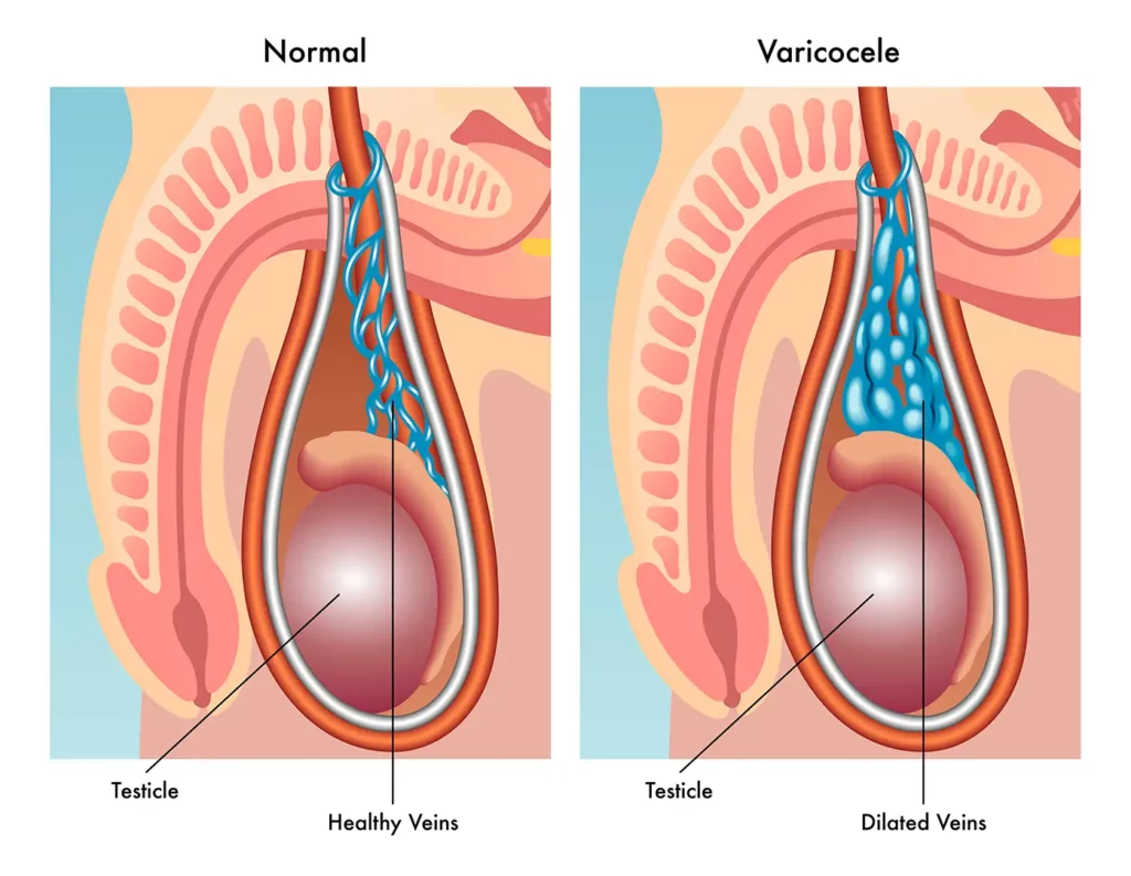 O QUE É VARICOCELE