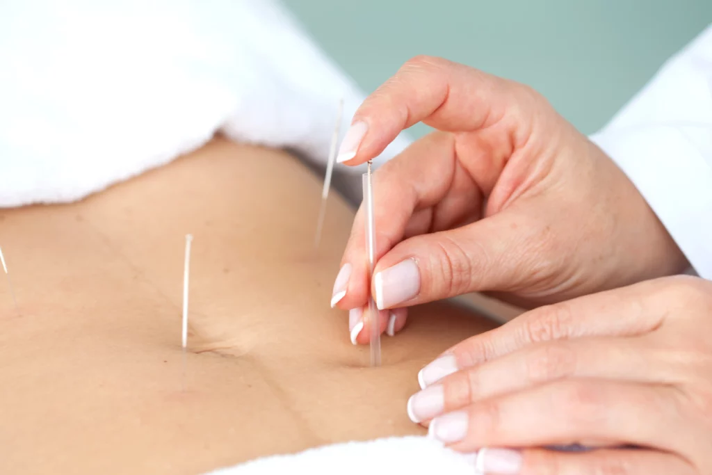Acupunturas para fertilidade